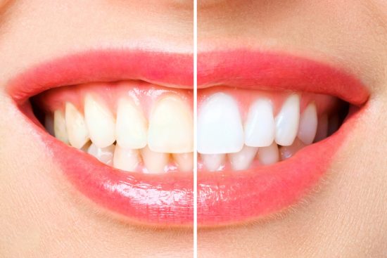 How to Naturally Whiten Your Teeth at Home